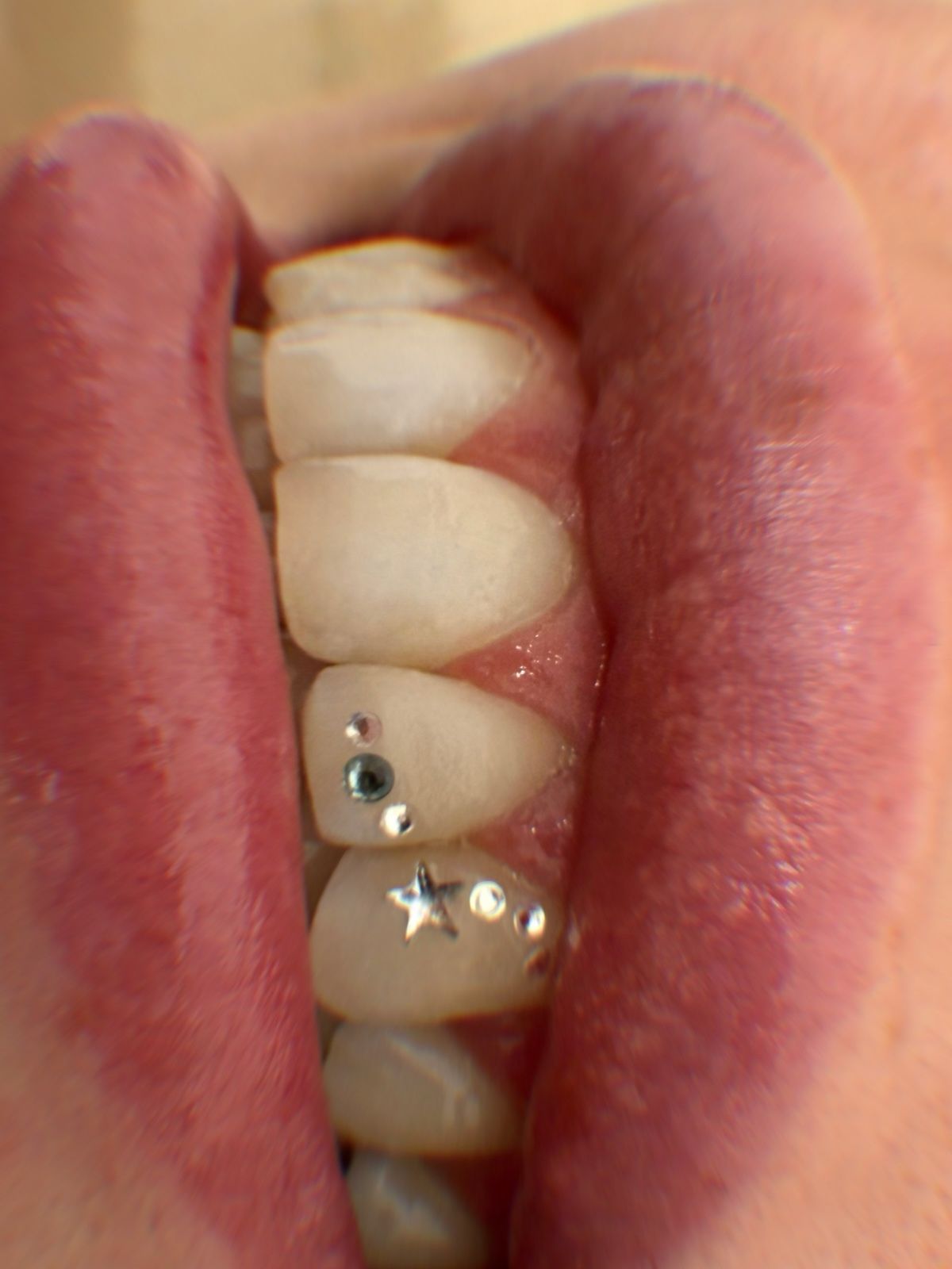 Tooth Gems mit Stern und Kristallen auf den Zähnen, seitliche Nahaufnahme